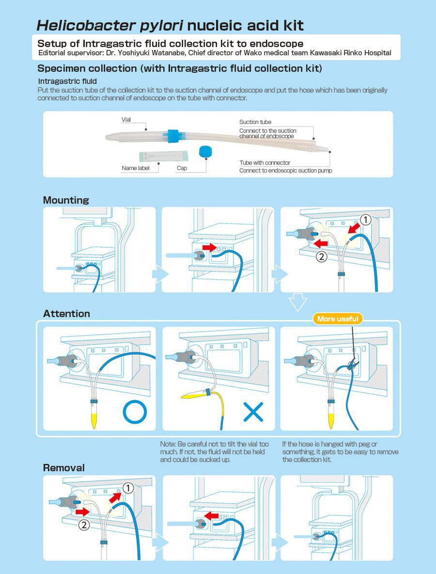 Setup of Intragastric fluid collection kit