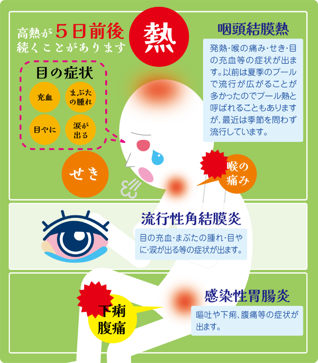 アデノウイルス感染症ってどんな病気？