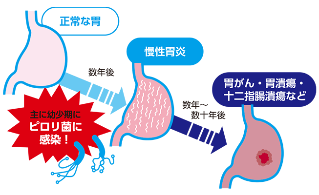 ピロリ菌と疾患の関係