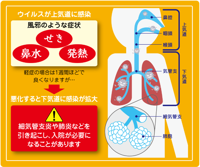 RSウイルスとヒトメタニューモウイルスの症状